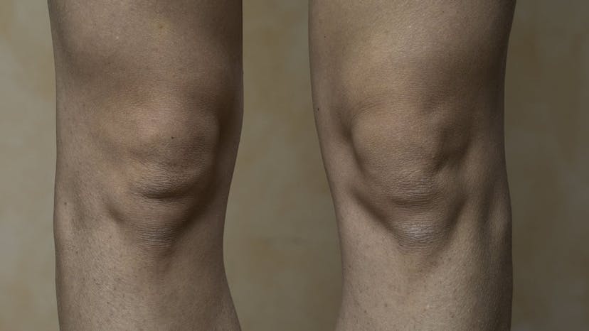 Artros i knän eller höftleder ökar risken för andra sjukdomar